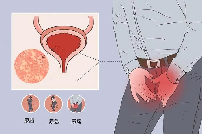 尿道炎是什么原因